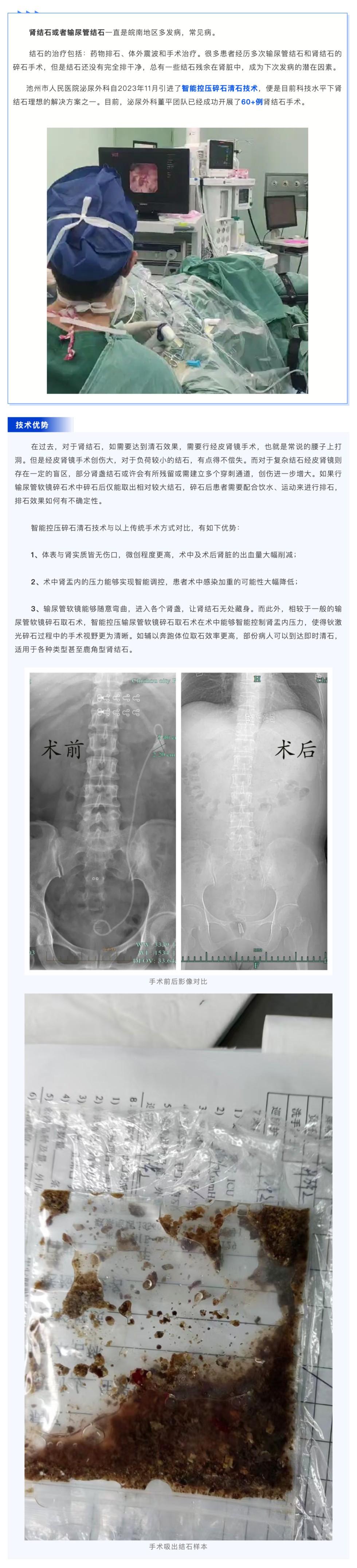 超微創(chuàng)！池州市人民醫(yī)院智能控壓輸尿管軟鏡讓結(jié)石無處遁形_壹伴長圖1.jpg